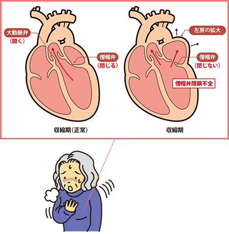 正常（左）と正常でない（右）僧帽弁